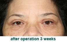 plastic-surgery-blepharoplasty